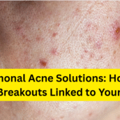 Hormonal Acne Solutions: How to Treat Breakouts Linked to Your Cycle