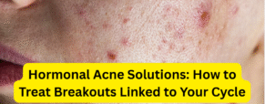 Hormonal Acne Solutions: How to Treat Breakouts Linked to Your Cycle