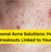 Hormonal Acne Solutions: How to Treat Breakouts Linked to Your Cycle