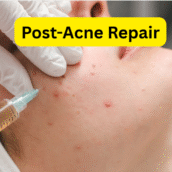Post-Acne Repair: How to Fade Scars and Hyperpigmentation Fast