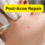 Post-Acne Repair: How to Fade Scars and Hyperpigmentation Fast