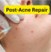 Post-Acne Repair: How to Fade Scars and Hyperpigmentation Fast
